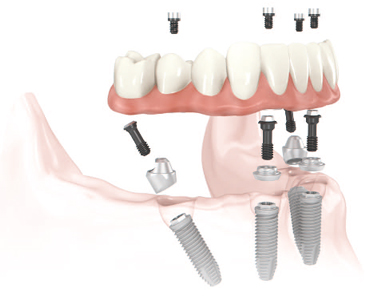 Full Smile Restoration in Ohio