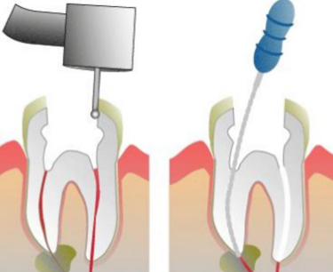 tooth pulp Removal Comfortable Root Canal 