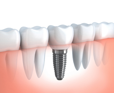 Replacing single tooth Same day Dublin