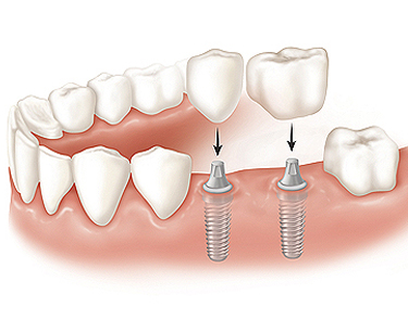 replacing multiple teeth in Columbus Ohio