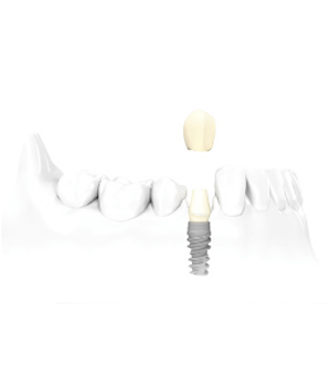 Single tooth Implant in Dublin Ohio