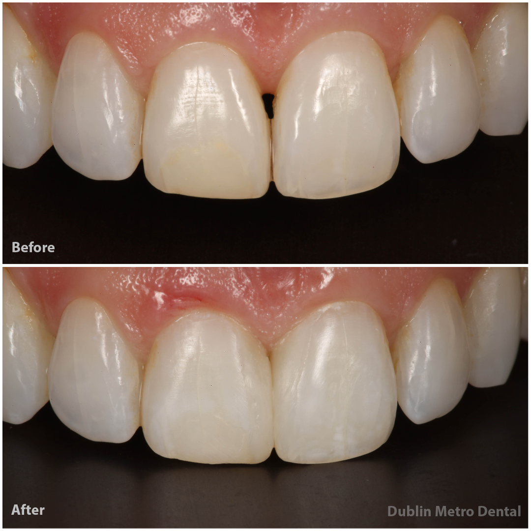 Black Triangle Gaps Between Teeth