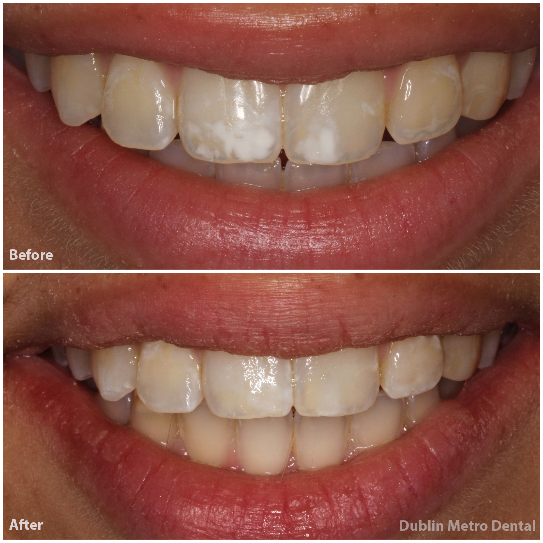 Tooth Bonding - Oral Health Center-Dental Care Westerville