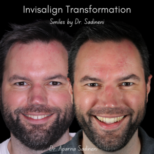 invisalign dublin ohio