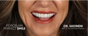 Porcelain Veneers Dublin, Columbus OHio
