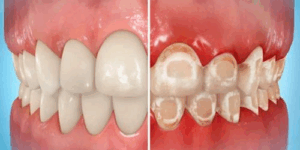 6 Reasons to Treat White Spots on Teeth Early 2 Teeth White Spots