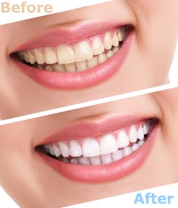 teeth whitening treatments in columbus ohio