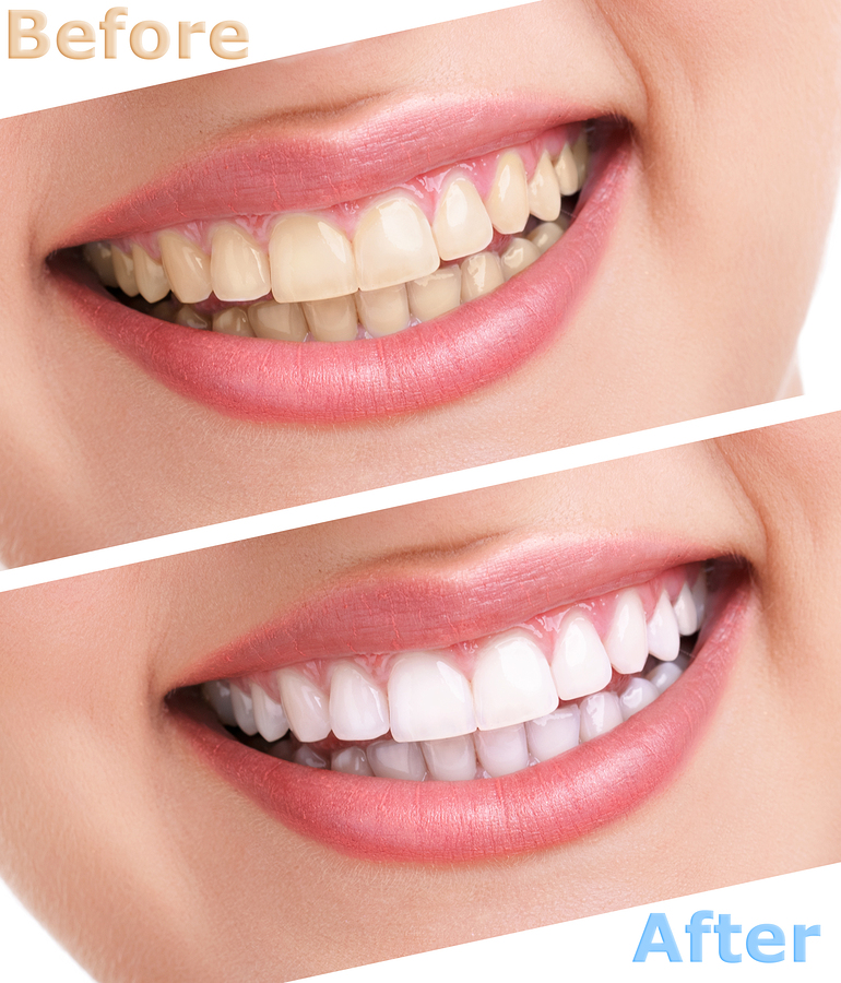 Cosmetic Dentistry San Diego