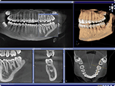 implant technology 3D CAT Scan in Dublin Ohio